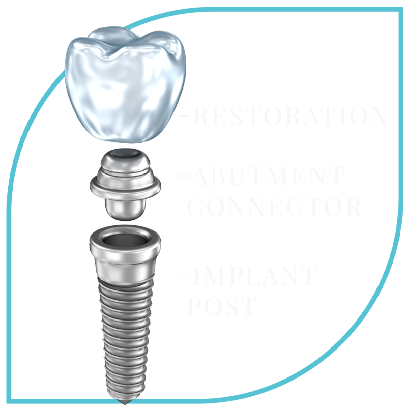 3 part dental implant graphic