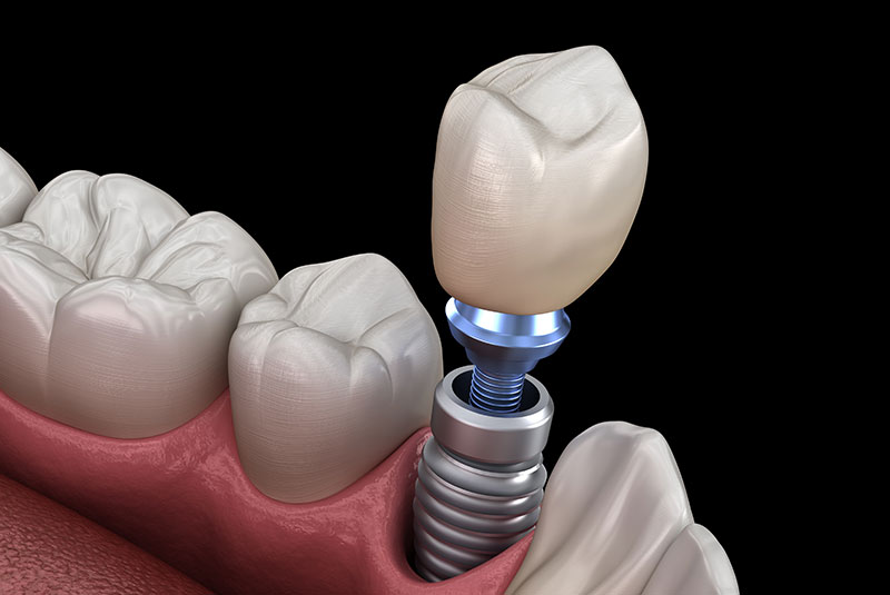 dental implant model