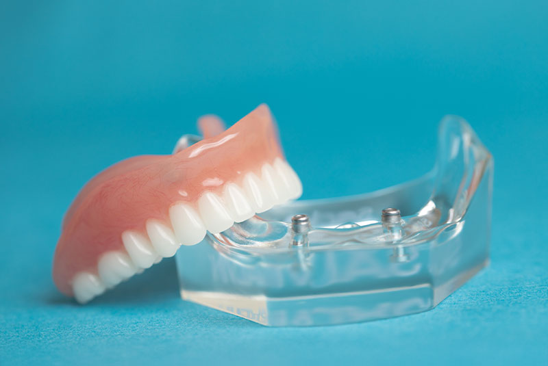 locator denture