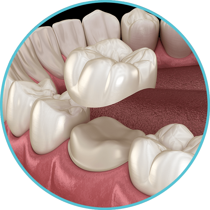 Dental Crowns