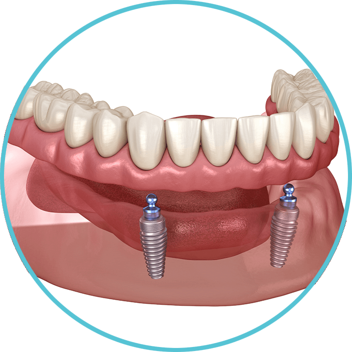 Snap dentures