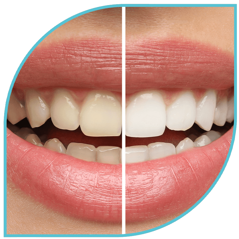 Teeth whitening