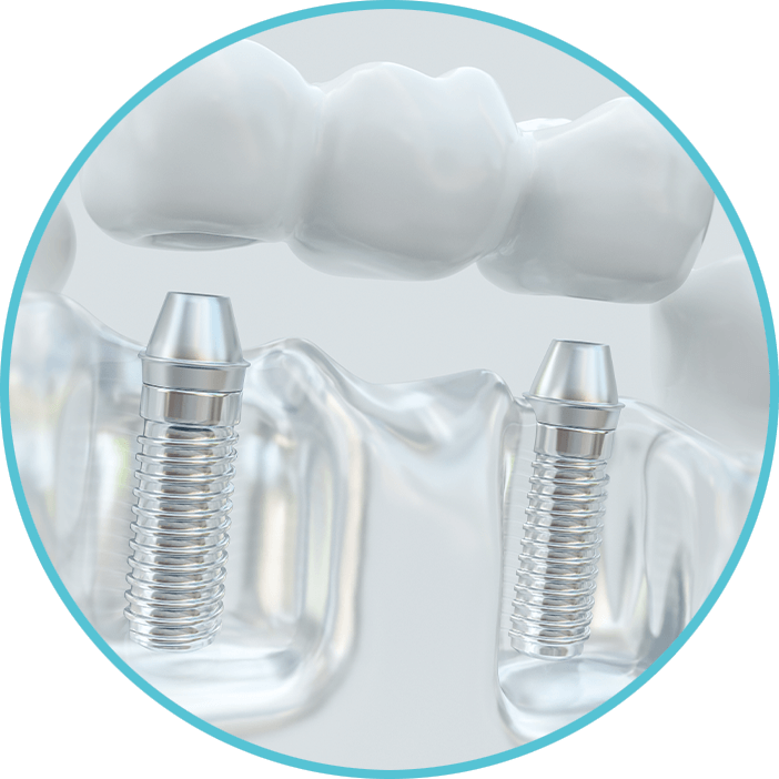 Dental implant Bridge