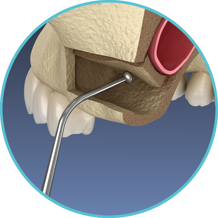 Sinus lift
