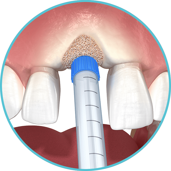 Socket Preservation