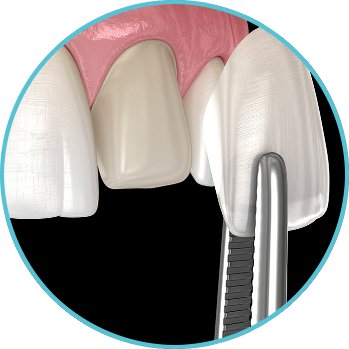 Veneers