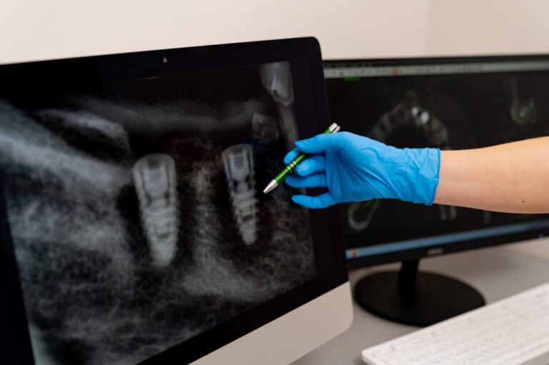 A gloved hand uses a pen to point at dental X-rays on a computer screen, focusing on two dental implants in the jaw. A second monitor shows more X-ray images in the background.