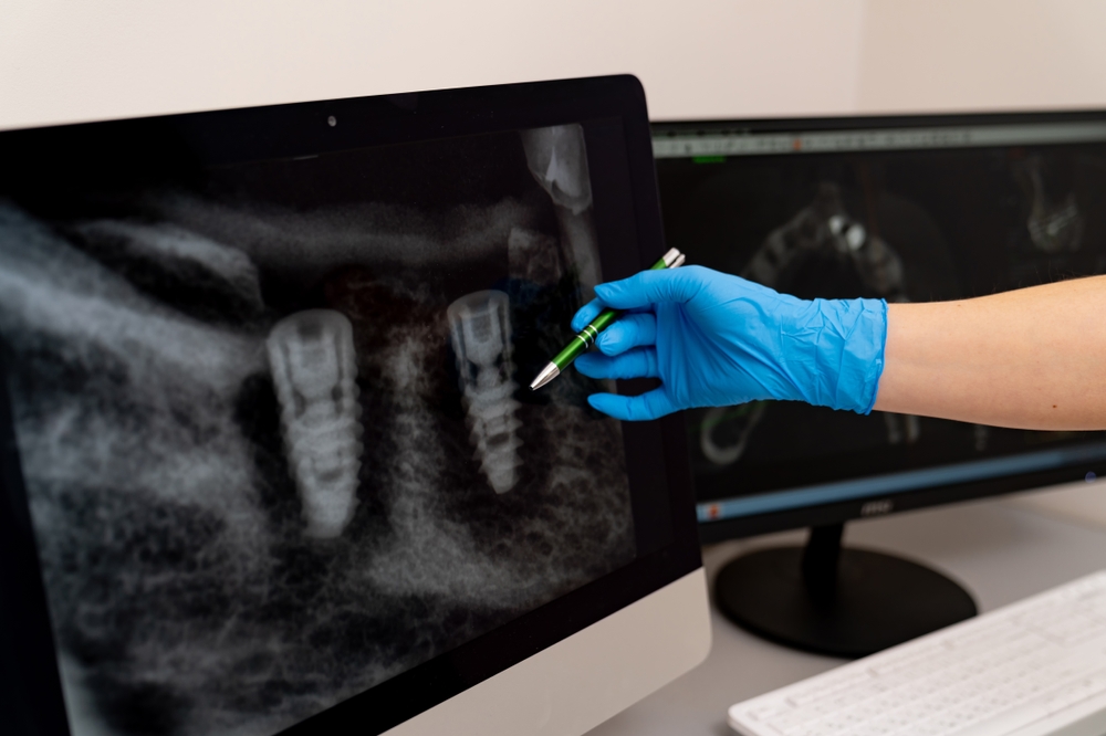 A gloved hand uses a pen to point at dental X-rays on a computer screen, focusing on two dental implants in the jaw. A second monitor shows more X-ray images in the background.